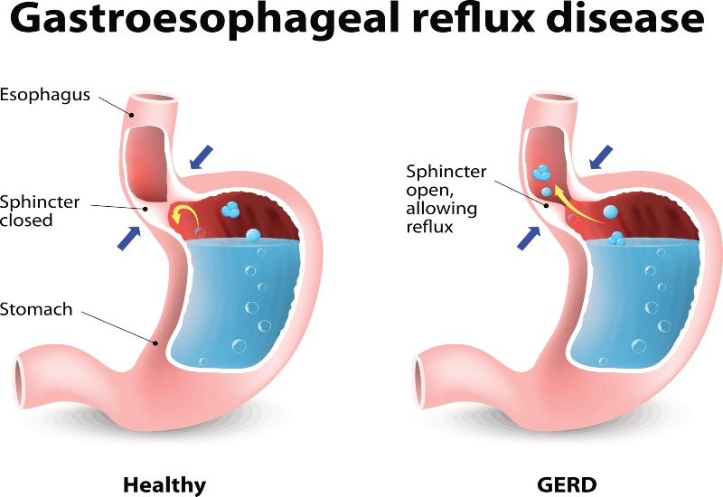 Gastro-Esophageal Reflux Disease Treatment in Atlanta