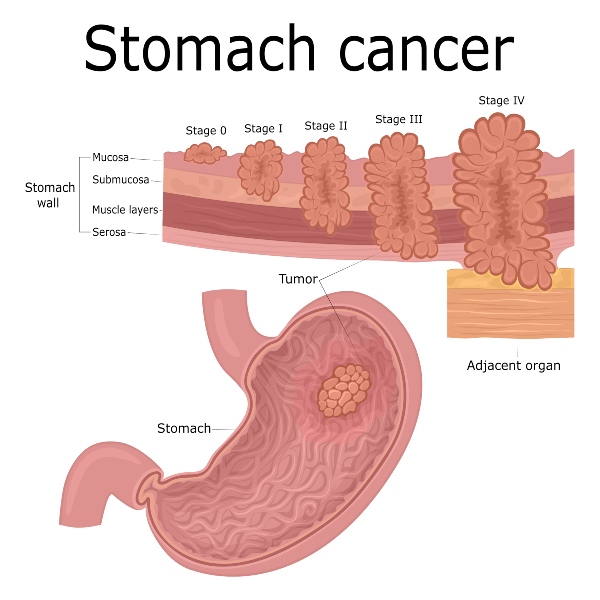 Stomach Cancer Treatment Options in Atlanta, Georgia