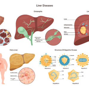 An illustration depicting liver disease relevant to the Atlanta, GA area