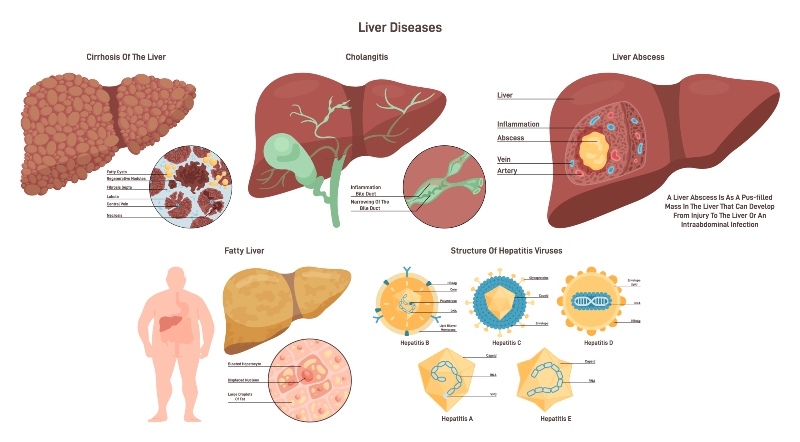 Illustration Showing Fatty Liver Disease, Related to MASH & MASLD, in a Human Body in Atlanta, GA