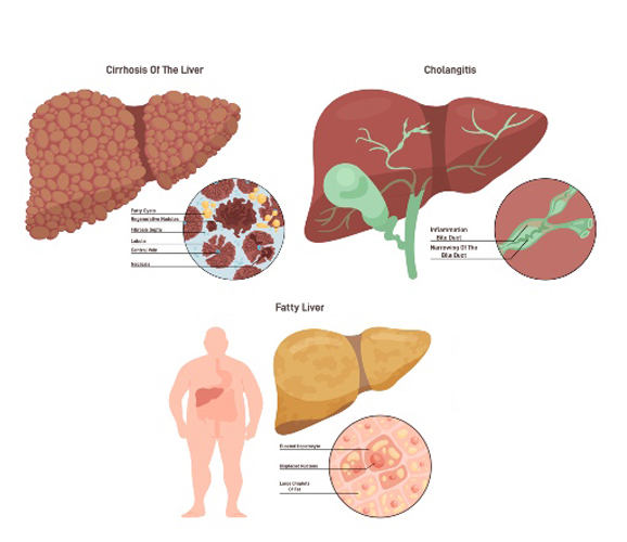 Illustration Showing Fatty Liver Disease, Related to MASH & MASLD, in a Human Body in Atlanta, GA