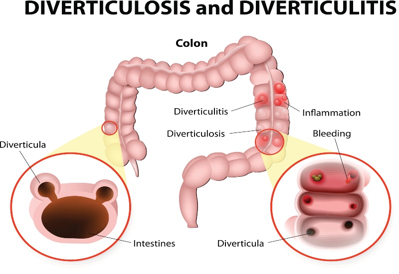 diverticulitis symptoms and causes